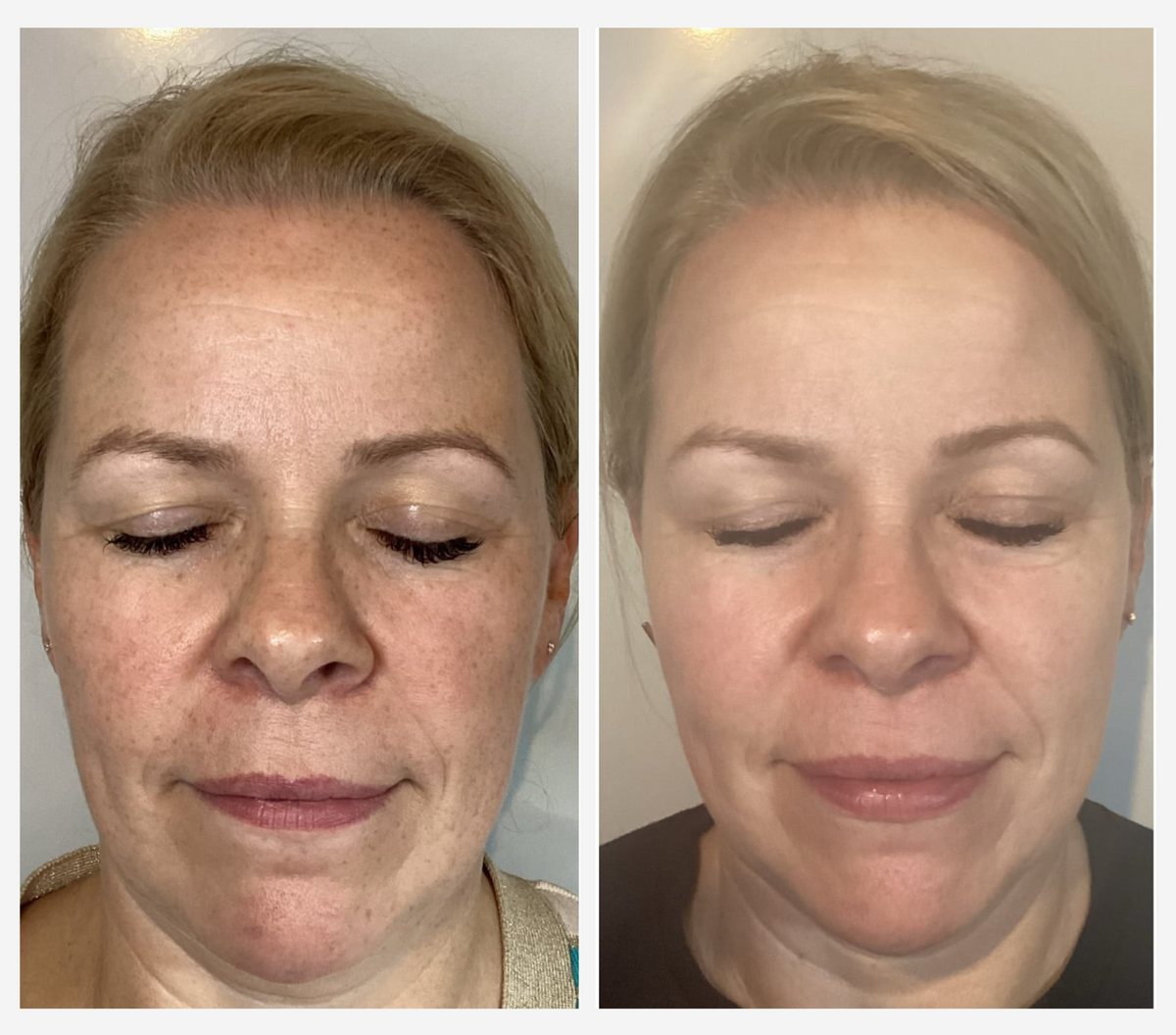 A side-by-side before and after comparison of a woman's face, showing skin texture and appearance changes. The left panel shows a woman with closed eyes, showing some visible blemishes and texture, while the right panel shows a smoother, clearer complexion.