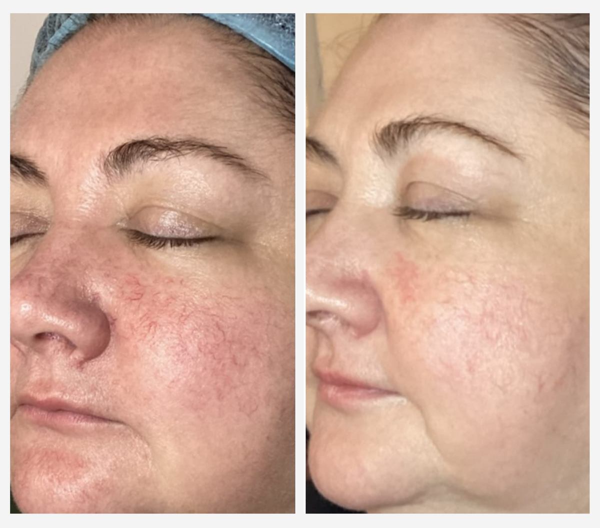 Before-and-after side-by-side close-up comparison of a woman's face, showing visible red facial veins on the left cheek and nose area, and a clearer, smoother complexion on the right.