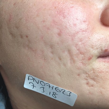 Acne Scarring Before
